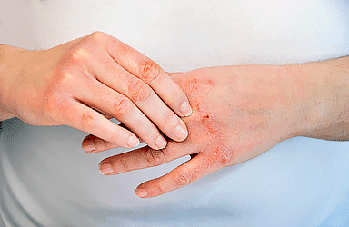 Ways that physiotherapists and biokineticists help with Dermatomyositis