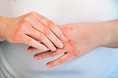 Ways that physiotherapists and biokineticists help with Dermatomyositis